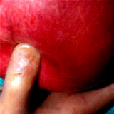fibroid_18kg2